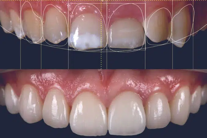 Smile Design & Makeovers